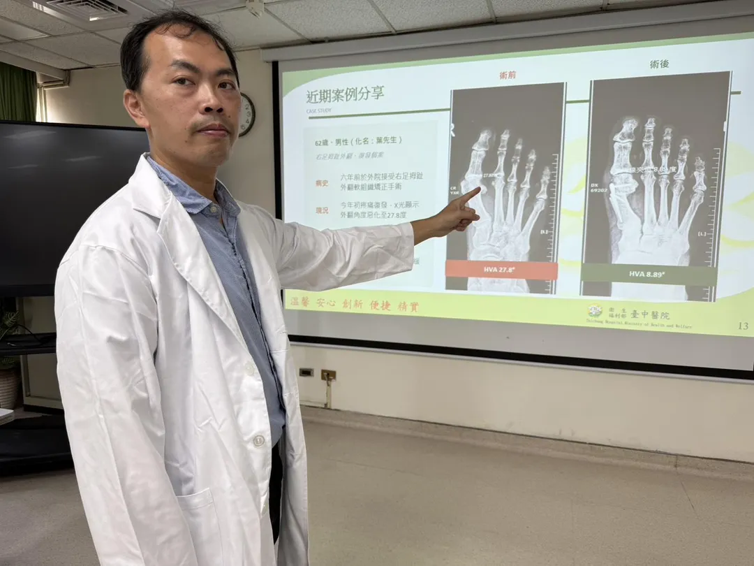 骨科周育名醫師說明患者到院時，右腳拇指外翻28度（左圖），經過截骨矯正手術為8.89度（右圖），已經可以正常行走。（圖／臺中醫院）