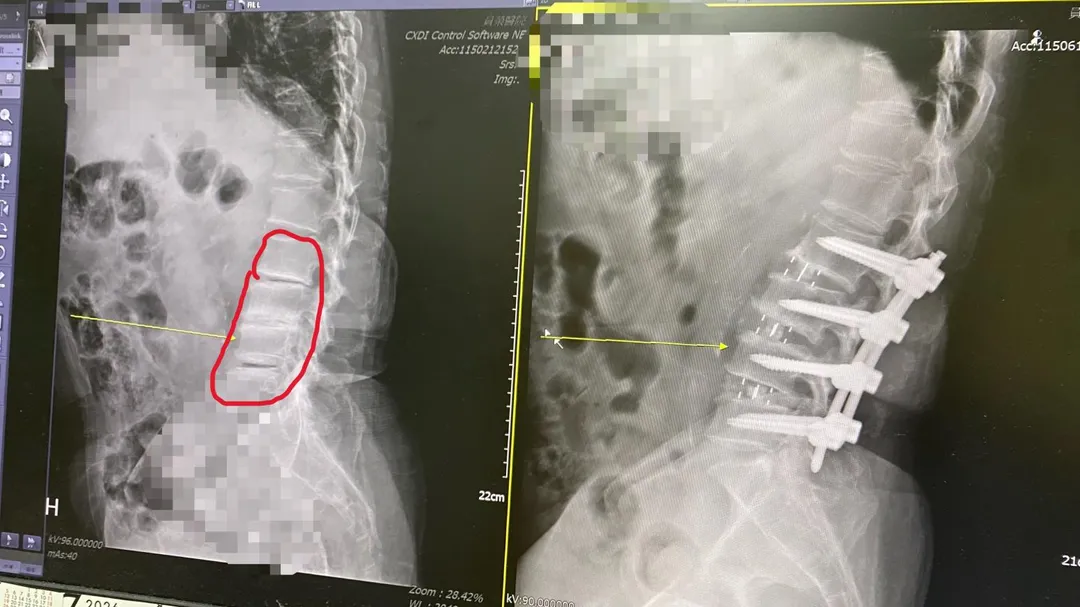 曾姓患者經影像學檢查發現為第二至第五腰椎退化性椎間盤疾病（左紅圈處），經 「斜位腰椎椎間融合術」（右）後，已能行動自如。（圖／員榮醫院）