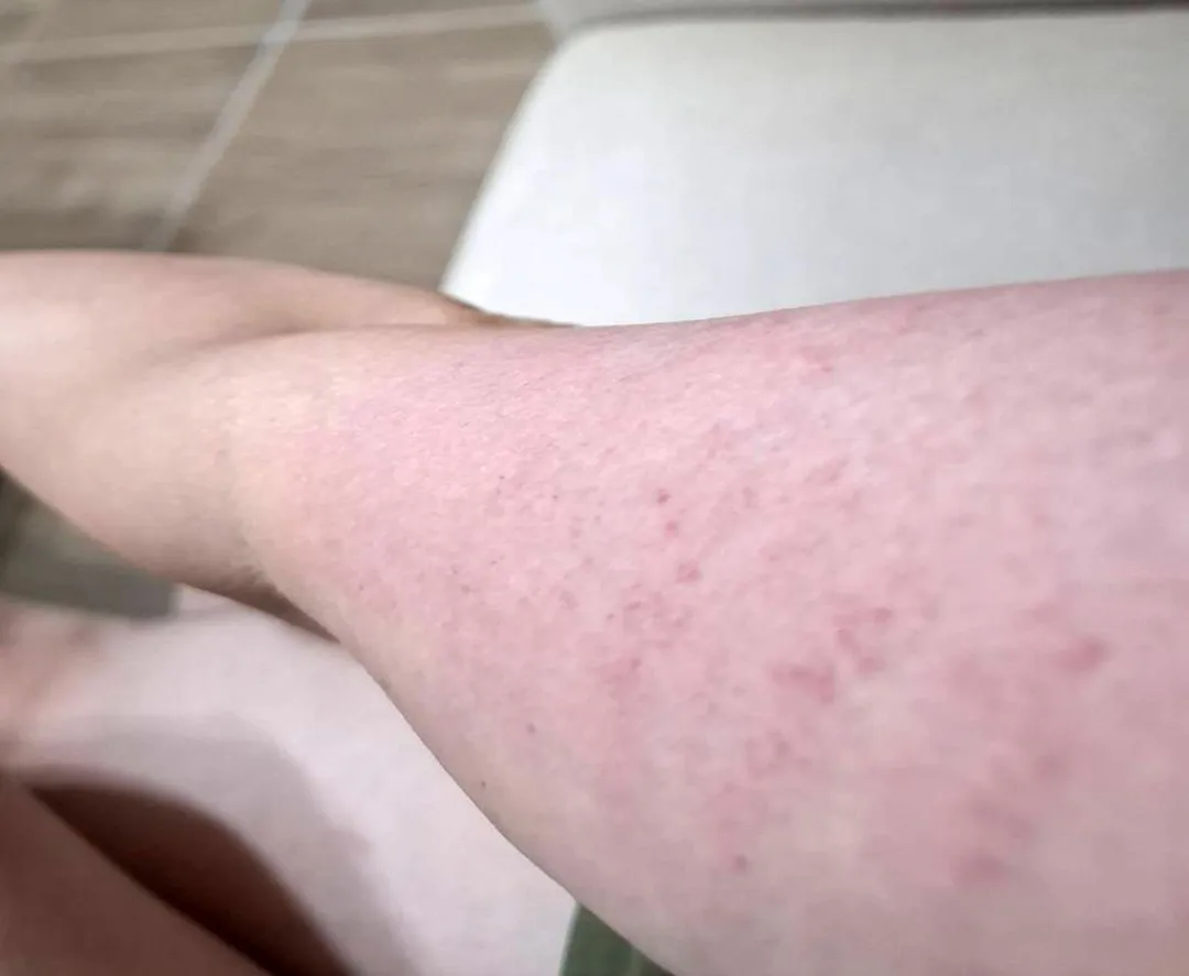 蔡姓女子皮膚癢的狀況。(圖/大林慈濟醫院提供)