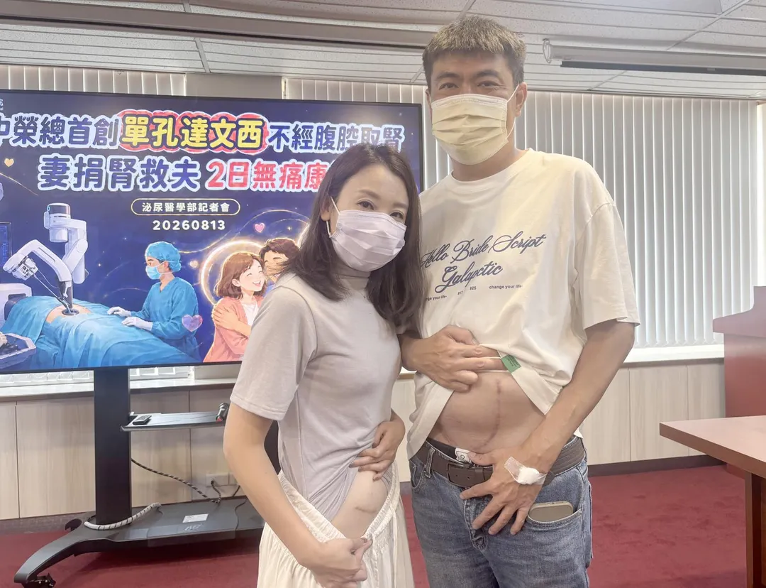 劉小姐(左)採單孔達文西手術取右腎捐給丈夫賴先生(右),在腹部留下一個取腎疤痕。(圖/臺中榮總)
