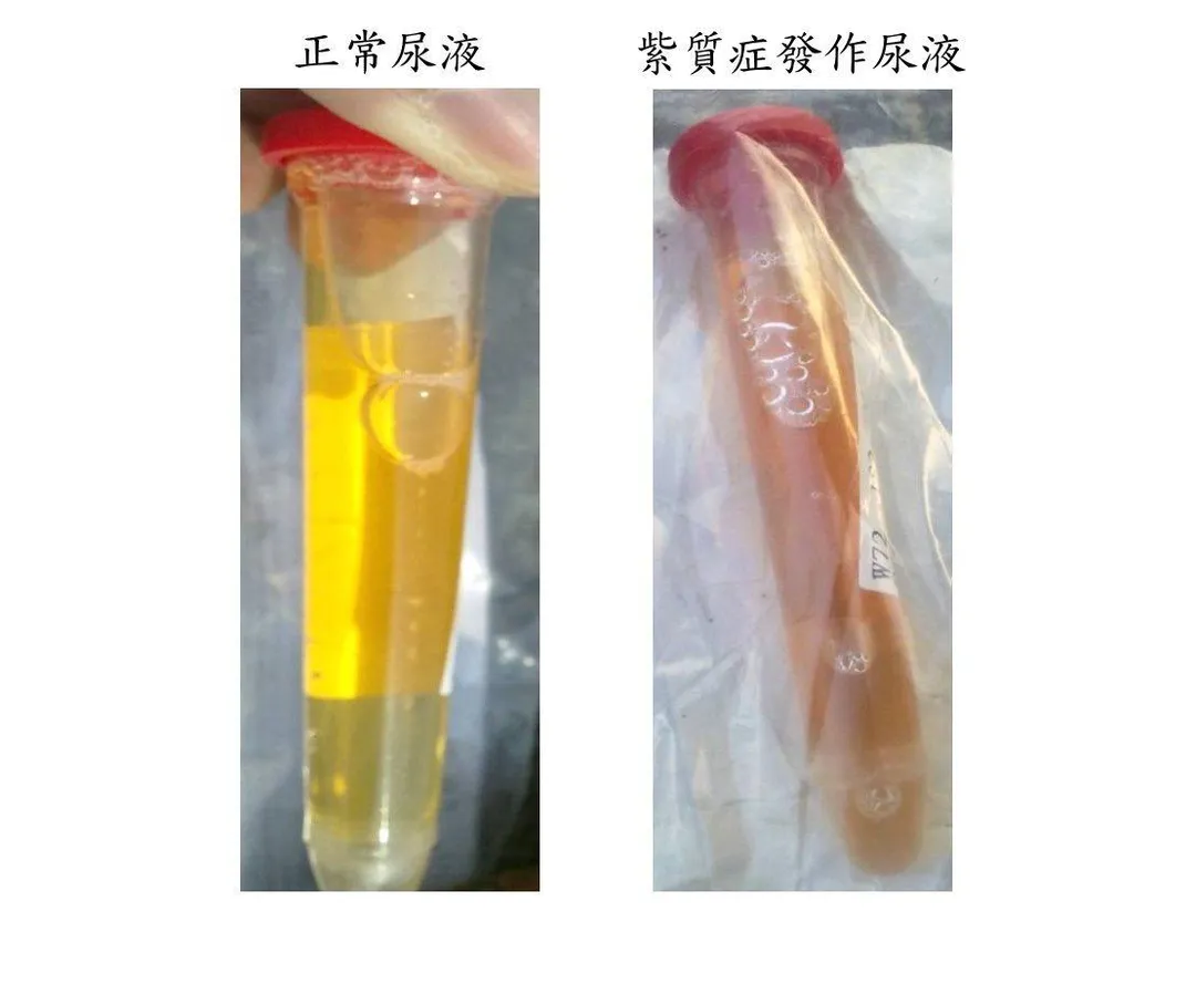 紫質症患者的尿液,發作時在光照下逐漸呈現紅棕色(右圖)。左圖為正常尿液。(圖/長庚醫院提供)