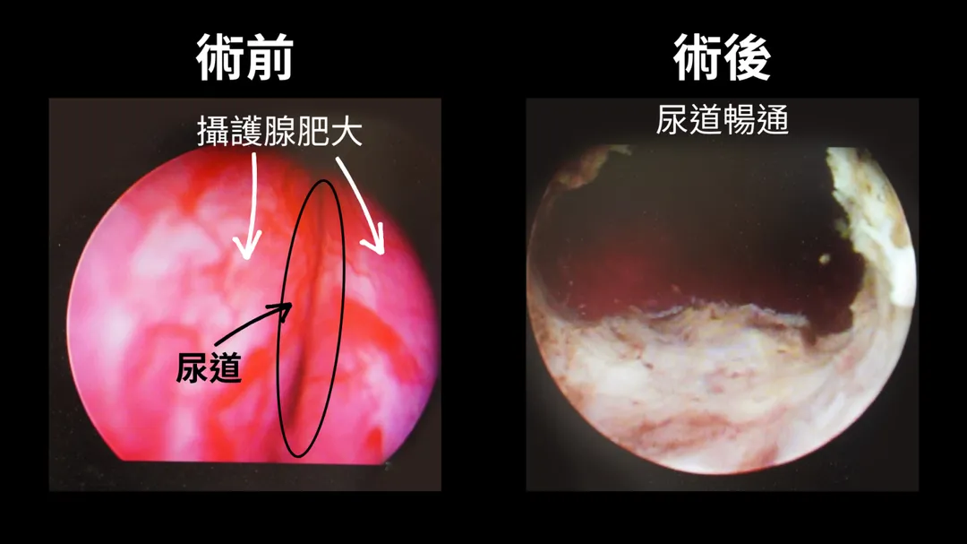 一名68歲男子多年排尿無力、尿流變細，近半年更出現解尿困難、尿不乾淨，卻以為只是老化。（圖／中國醫藥大學新竹附設醫院）