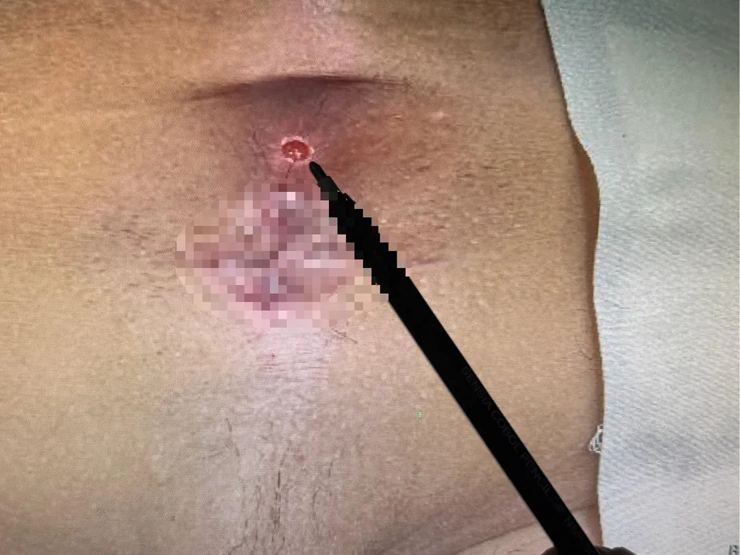 32歲陳先生8年來因肛門上方膿瘍反覆破裂（筆指處），常害他工作到一半「濕褲子」，相當困擾。（圖／臺中醫院）