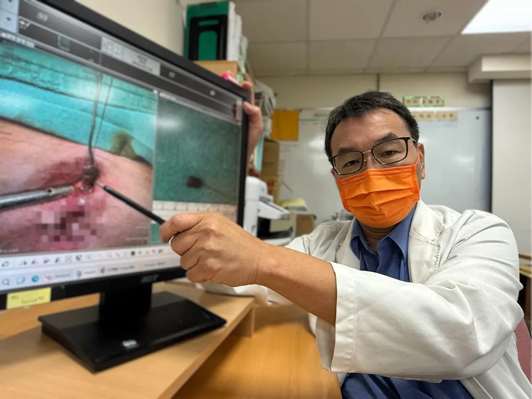 臺中醫院一般外科曾旭弘醫師幫患者進行廔管切除手術，並輔以高壓氧治療協助傷口加速修復。（圖／臺中醫院）