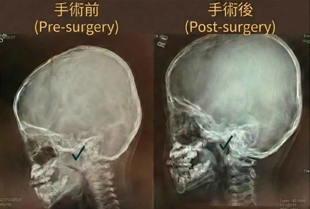 影像打勾處為腺樣體位置,切除手術前灰色區域為腺樣體肥大組織、壓迫鼻腔空間,術後恢復正常空間。(圖/台北慈濟醫院)