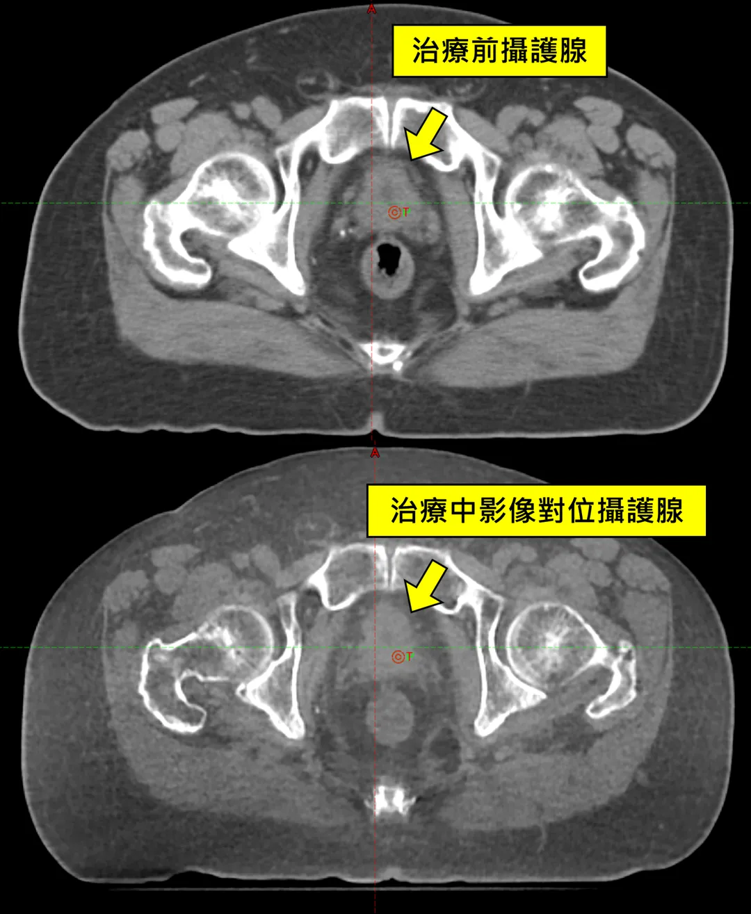 攝護腺癌治療前與治療中精準影像導引。（圖／安南醫院）