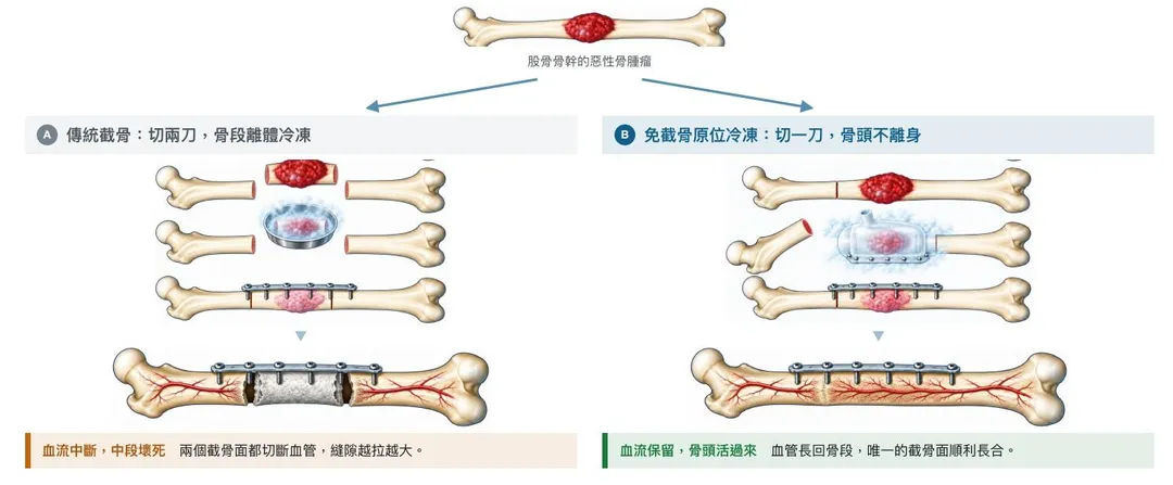 對比傳統切除兩截骨頭的顯著缺陷，「免截骨／少截骨」的新型冷凍重建技術降低併發症並加速患者復原。（圖／台北榮總）