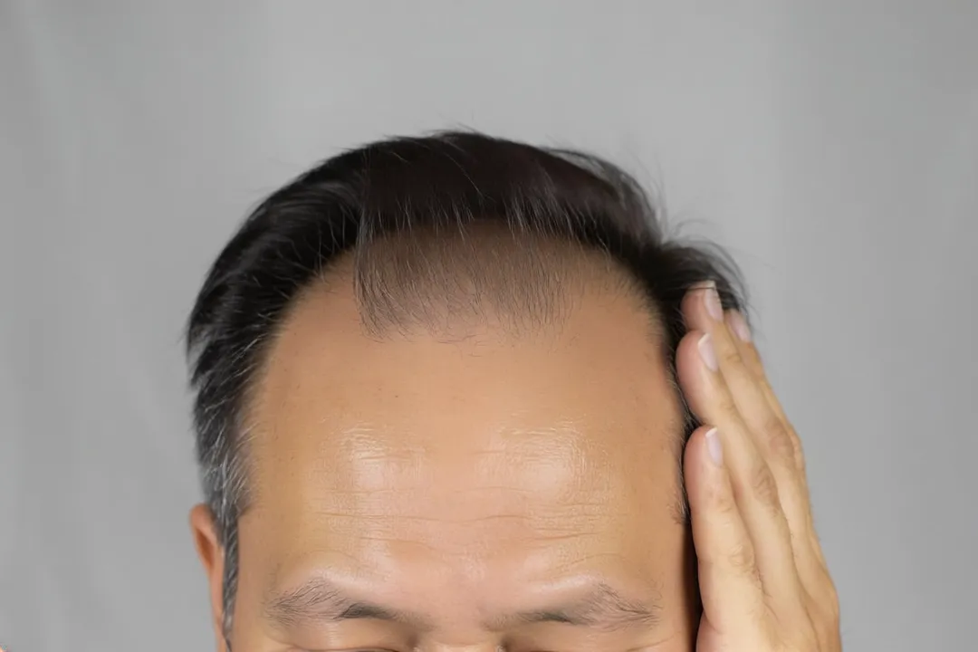 妨礙頭皮血液循環的食物若攝取過量，恐增加掉髮風險，其中烏龍麵、高脂肉類與酒精更是需要特別留意的三大地雷。&nbsp;（示意圖／AI生成）
