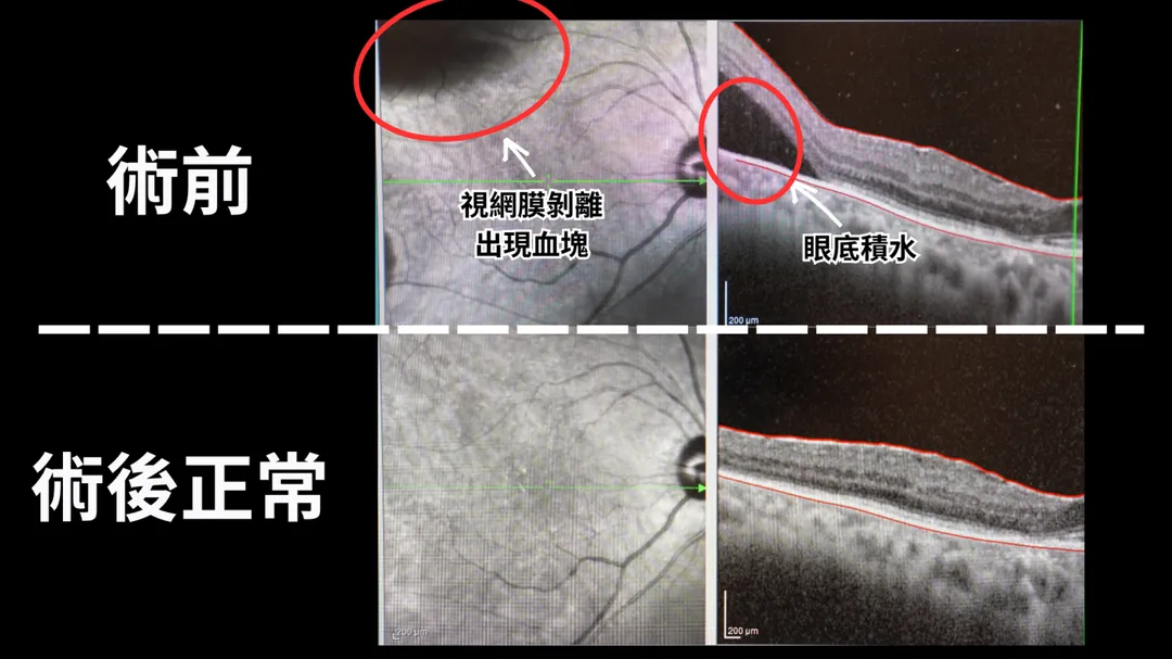74歲婦人突然發現右眼外側視野一片黑，短短2天內黑影逐漸往視野中央移動，幾乎無法看見。（圖／123RF）