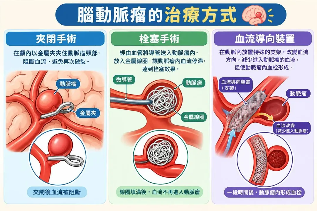 顏君霖指出，腦動脈瘤治療主要有「顯微夾閉手術」與「介入栓塞手術」。（圖／基隆長庚紀念醫院）