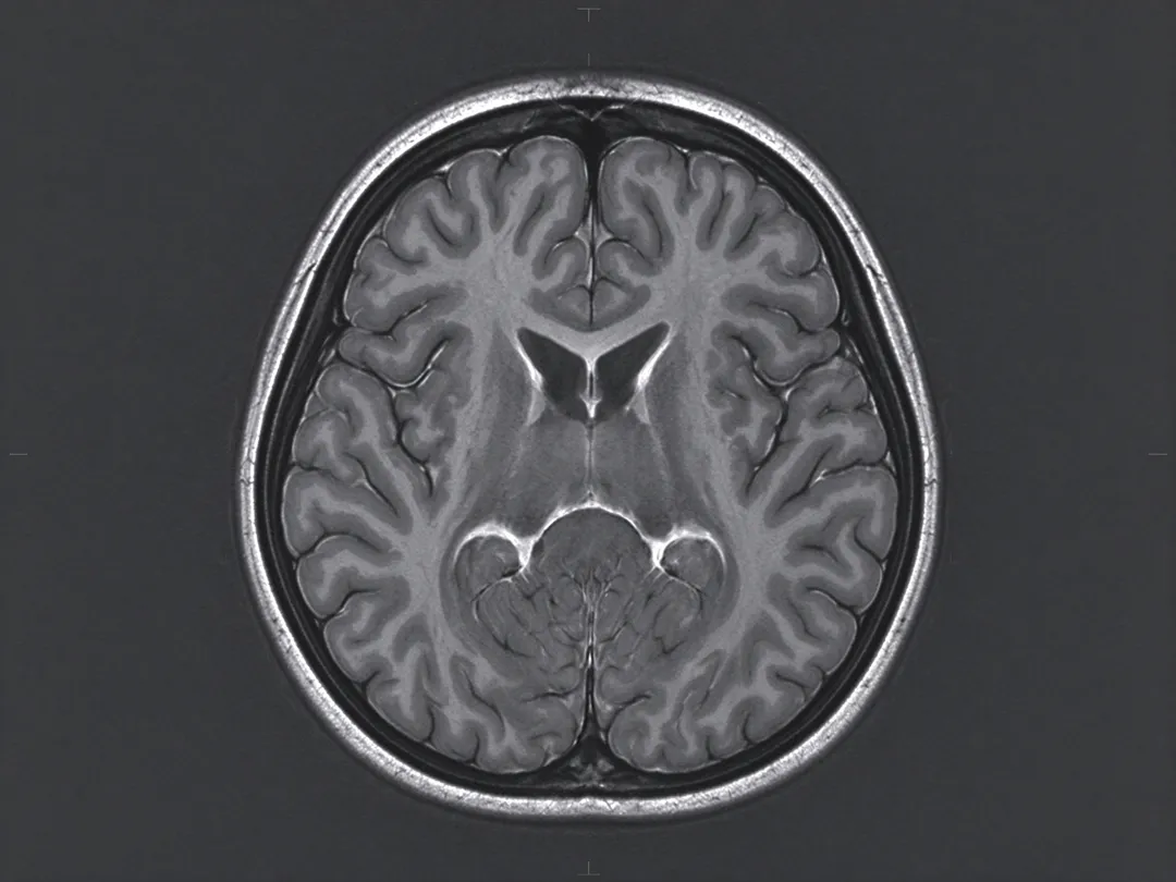若懷疑腦瘤，陳品元指出，目前最標準的檢查是腦部核磁共振（MRI），沒有輻射，也能清楚呈現腦部構造。（示意圖／AI生成圖）