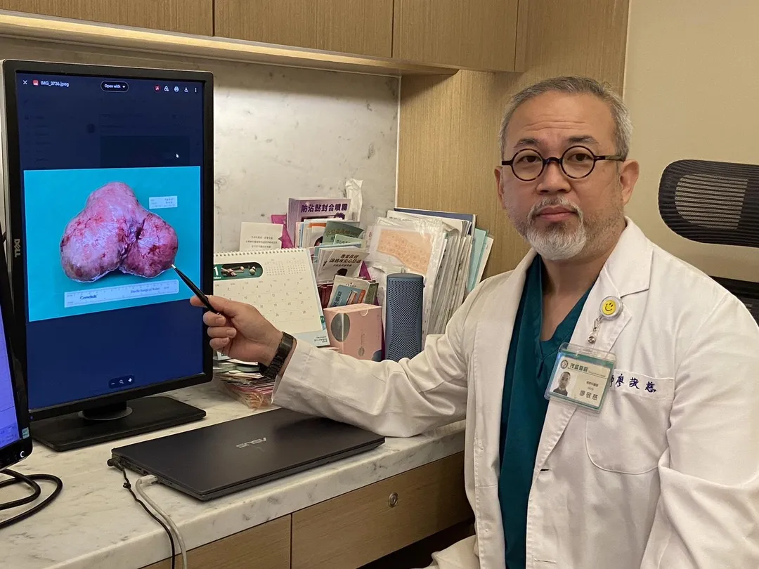 王小姐順利剖腹後,確認其為臨床上僅5%發生機率的「帶蒂肌瘤」,廖醫師憑藉30年豐富經驗,當機立斷於生產時一併切除。(圖/茂盛醫院)