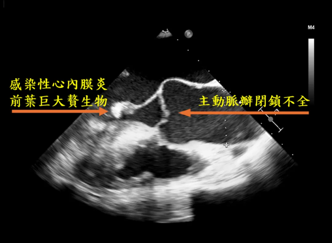 經食道心臟超音波影像，標示處可見主動脈瓣膜閉鎖不全，及因心內膜炎造成的贅生物。（圖／台北慈濟醫院）