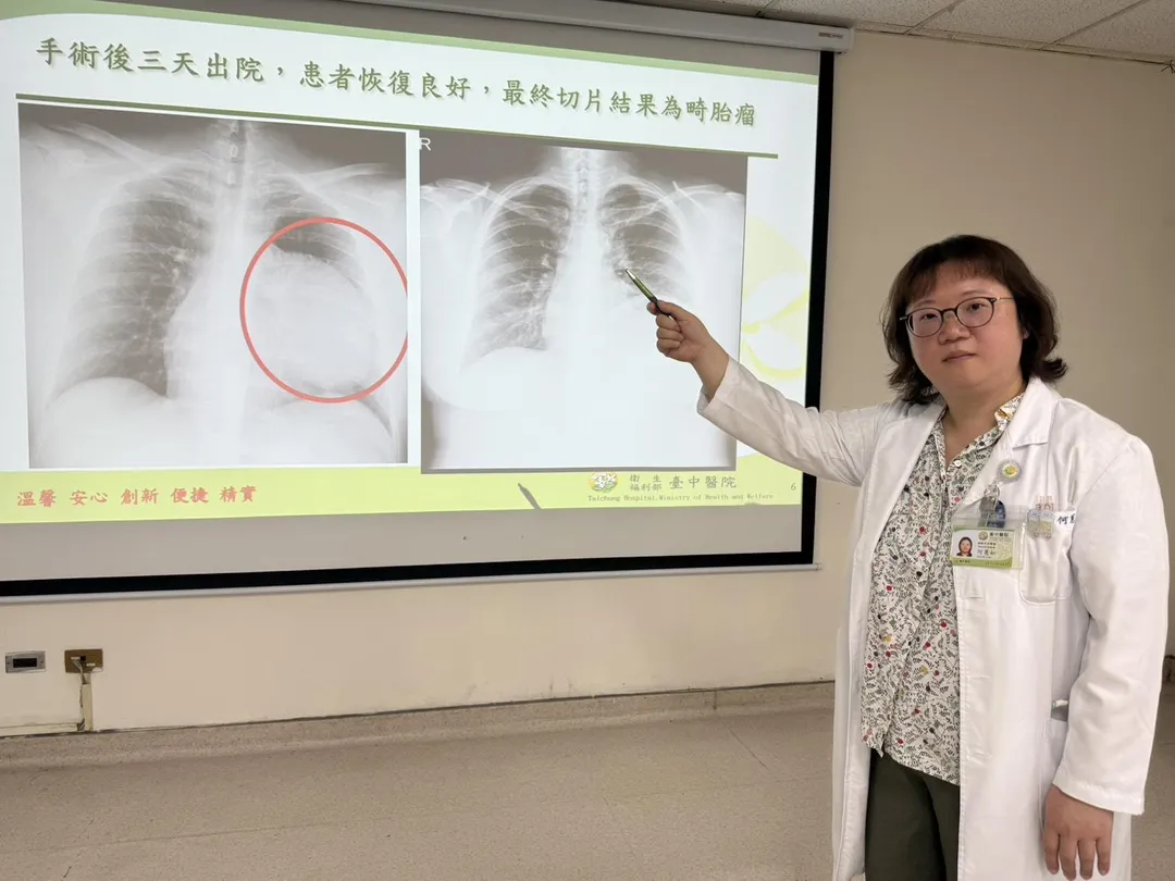 何蕙如醫師說明，患者因求職健檢意外發現左側縱隔腔有顆巨大腫瘤，經過胸腔鏡摘除之後左胸呼吸可正常擴張，無後遺症。(圖/台中醫院)