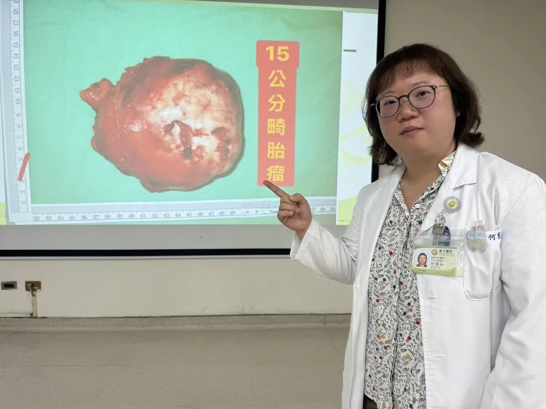 透過胸腔鏡完整切除的畸胎瘤約15公分，比一顆拳頭還大。(圖/台中醫院)