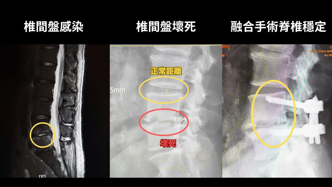 一名60歲男子流感快篩呈陽性後接受抗病毒藥物治療,後來出現劇烈腰痛,救醫檢查發現椎間盤被侵蝕。 (圖/中醫大新竹附醫)
