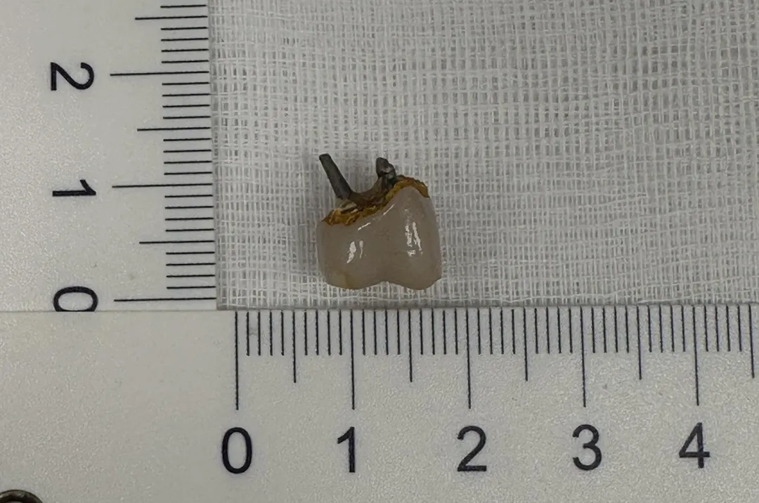 假牙具有金屬尖銳邊緣，長時間滯留仍可能摩擦腸壁，造成黏膜損傷、出血，甚至穿孔等併發症。（圖／馬偕醫院）