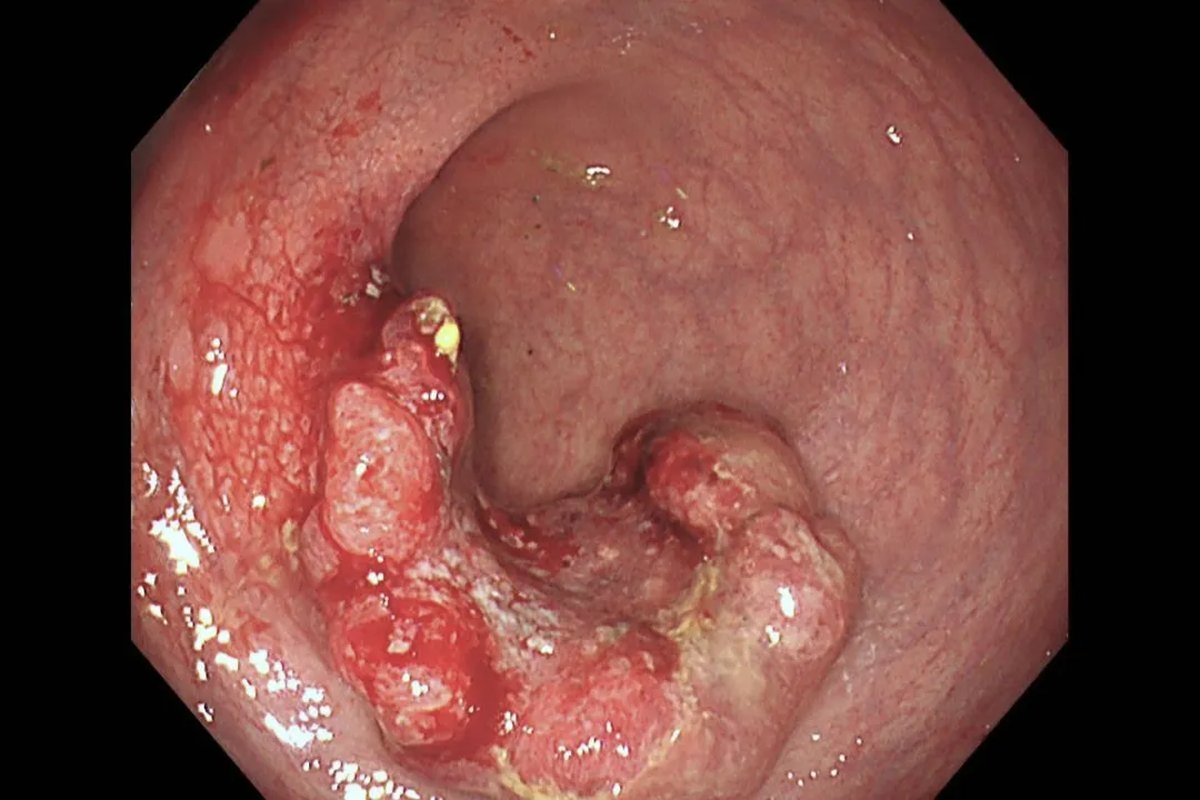 大腸鏡檢查可見腸道內腫瘤，圖為直腸癌腫瘤。（圖／台北慈濟醫院）