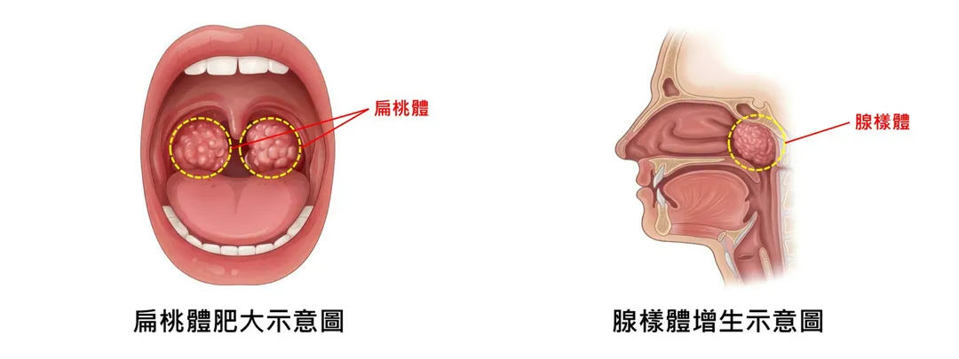 扁桃體肥大示意圖(左);腺樣體增生示意圖(右)。(圖/台中慈濟醫院)
