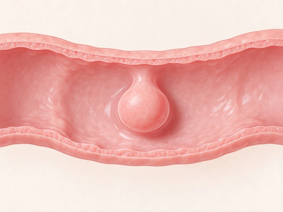 大腸癌多半會經過瘜肉逐漸生長、變化的過程,因此透過大腸鏡檢查發現瘜肉後切除,是預防大腸癌的重要方法。(示意圖/AI生成圖)
