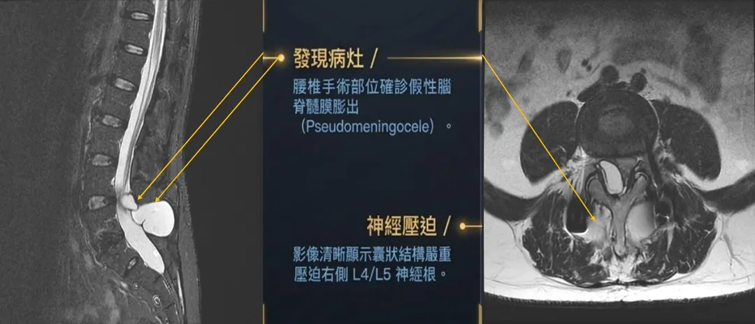「核磁共振(MRI)影像顯示,病患腰椎手術部位確診為『假性腦脊髓膜膨出』,影像可見囊狀結構嚴重壓迫右側 L4L5 神經根。」(圖/大林慈濟醫院)