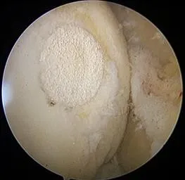 再清創之後，將原本軟骨損傷的部位進行一次性軟骨的移植。（圖／安南醫院）