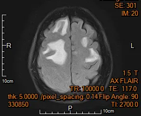 翁女士的MRI核磁共振檢查顯示有轉移性腫瘤合併嚴重腦水腫。（圖／烏日林新醫院）