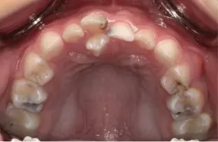 5歲女童小琳(化名)因檢查發現口內異常,轉診至奇美醫院後,竟發現同時存在正向與逆向多生牙,且合併多顆嚴重蛀牙。(圖/奇美醫院提供)