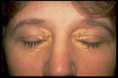 黃色瘤是因為血液中的低密度脂蛋白膽固醇過高，滲透至皮膚真皮層形成脂肪堆積所致。(圖/振興醫院臉書)