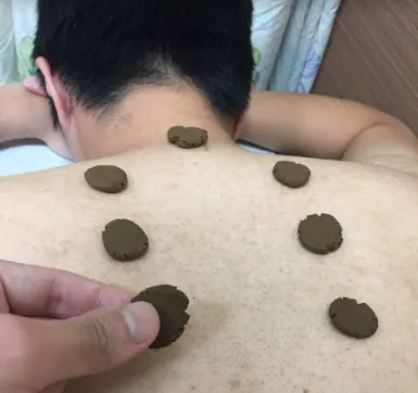 夏日炎炎，中醫師表示，現在起到8月30日前，正是利用「三伏貼」進行「冬病夏治」最佳時機。（圖／翻攝自幸福翰醫堂中醫師陳信宏個人網站）