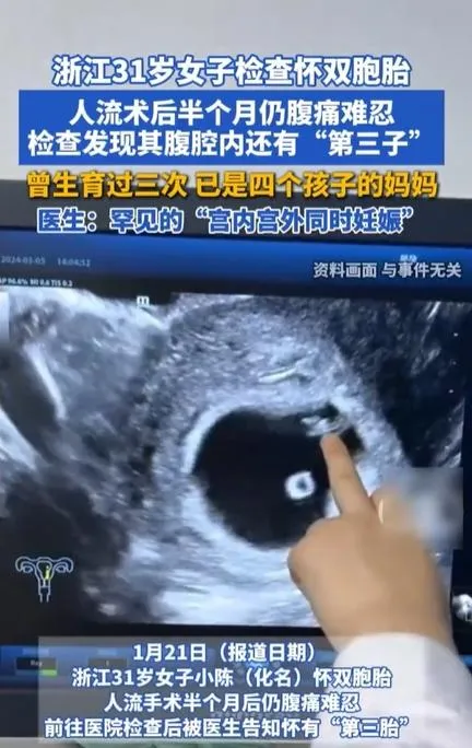 一名女子進行雙胞胎人流手術後半月後竟發現還有「第3子」。（圖／翻攝《舜網》）