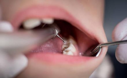 女星牙齒變色痛到無法工作！就醫發現「增生小牙」緊急根管治療
