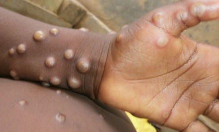 猴痘案例不斷新增！營養師曝這5類人是危險群　補充「3維生素」可預防