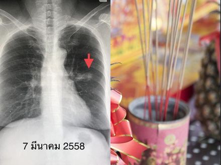 65歲女不抽菸…「每周燒20根香」拜佛　竟罹患肺癌2期