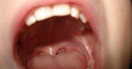 39歲女口腔潰爛一年未癒　因罹癌被迫「割舌」喪失說話能力