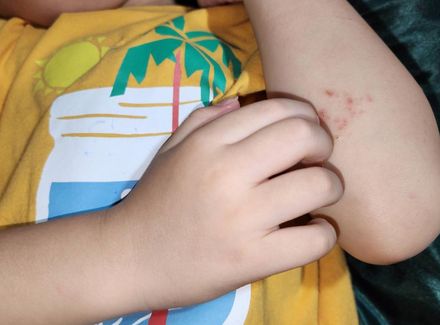 5歲童搔癢抓到破皮流血　醫授3招減緩異位性皮膚炎不適！
