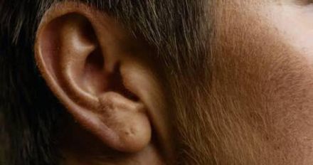 男子耳朵爆痛就醫竟發現　耳道藏有「11隻蟑螂」！