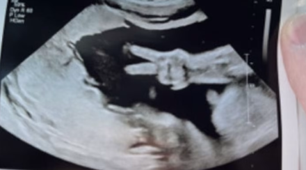 絕了！31周胎兒「肚裡比YA」父母瞬間笑噴　無私分享超音波照