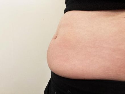 女子腹痛難忍就醫　驚見卵巢長「逾10公斤重」腫瘤：我以為只是變胖