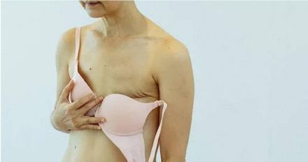 7旬婦下肢癱瘓竟是乳癌作祟！醫驚見「巨大乳房腫瘤」：癌細胞轉移到脊椎了