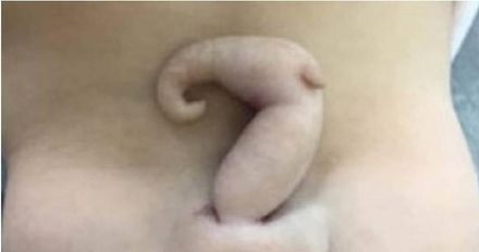 超罕見！巴西女嬰出生帶「6公分尾巴」　全球不到200例！