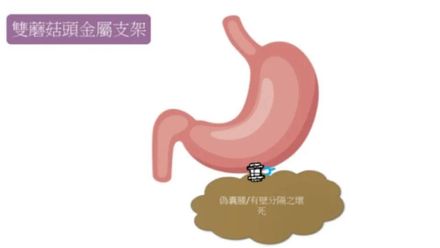 腹痛竟是「急性壞死胰臟炎」！三總「內視鏡清創」2個月成功清完