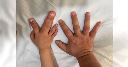 2歲童患「巨指症」手指超巨大！醫曝：若達1條件恐截指