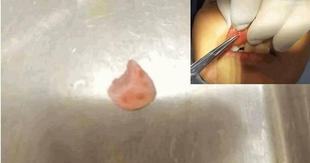 驚！婦人跌倒嘴唇腫脹1個月　竟「卡半顆牙」醫護驚呆