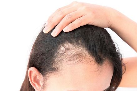 頭髮一直掉好煩！醫曝「11種常見原因」恐和這些疾病有關