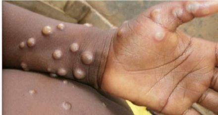 國內首例猴痘死亡！30歲男皮膚膿瘍、壞疽　就醫才知染「愛滋」