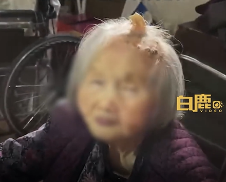 影/獨角「壽」？廣東107歲老婦「頭頂長角」網稱長壽象徵　醫籲就診檢查