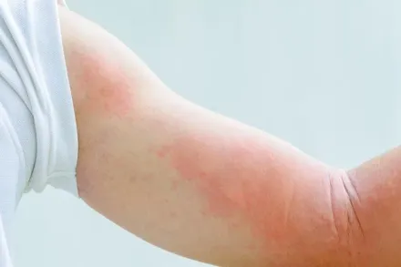 換季就牙起來！蕁麻疹全身癢爆怎辦？ 皮膚科醫認證「7大止癢攻略」