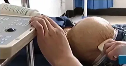 四川91歲嬤跌倒檢出懷胎60年　腹中「兒子」已石化、就是不想生