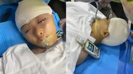 影/腦漿都出來了！9歲女童遭男師打碎頭骨　開顱手術5小時仍在危險期